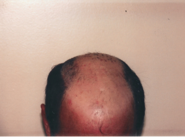 Hair Loss Restoration